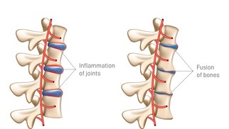 Ankylosing Spondylitis: Causes, Symptoms, Diagnosis, and Treatment Ankylosing Spondylitis: Causes, Symptoms, Diagnosis, and Treatment